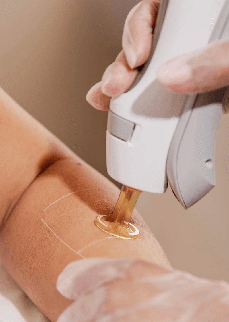 Laserontharing met de GentleMax Pro Plus: hoe werkt het en wat mag je verwachten? - 3